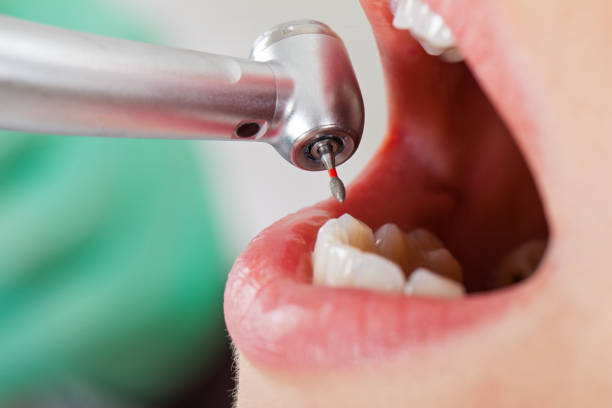 Best Emergency Root Canal Treatment in Lakeview, CA